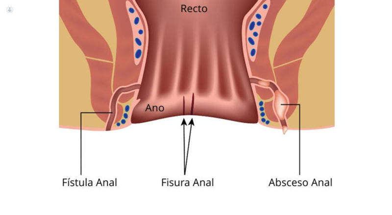 imagen fistula anal