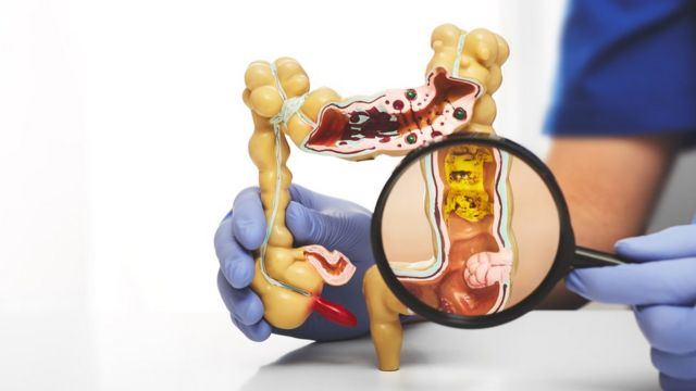 enfermedad diverticular